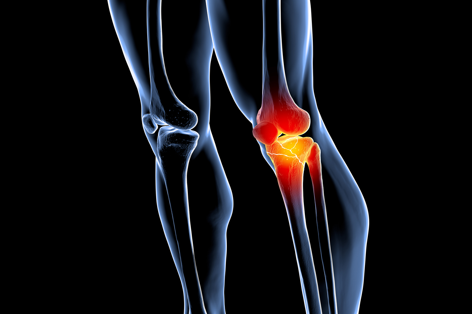 Sümük əriməsi nədir və necə müalicə olunur?