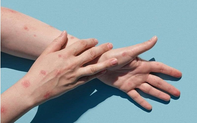 SN: Azərbaycanda meymunçiçəyi ilə bağlı real epidemioloji təhlükə mövcud deyil